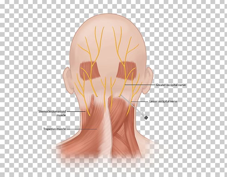 Occipital Neuralgia Greater Occipital Nerve Occipital Artery Chronic Pain Pain Management PNG, Clipart, Back Pain, Chronic Pain, Face, Hand, Hand Model Free PNG Download