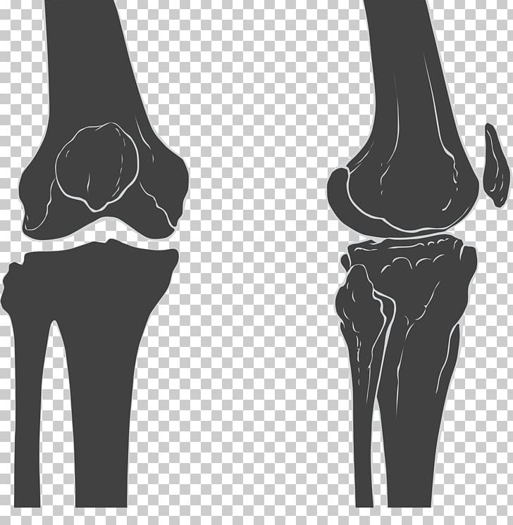 Knee Joint Femur Patella Bone PNG, Clipart, Arm, Black And White, Bone, Femur, Finger Free PNG Download
