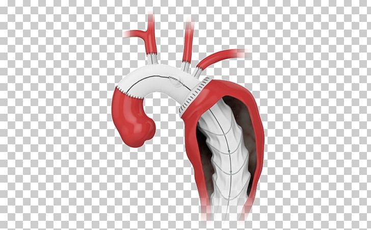 Aorta Prosthesis Endovascular Aneurysm Repair Stenting Surgery PNG, Clipart, Anastomosis, Aneurysm, Aorta, Ascending Aorta, Blood Vessel Free PNG Download