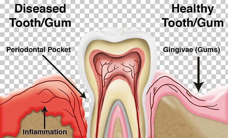 Periodontal Disease Gums Periodontology Dentistry PNG, Clipart, Bleeding On Probing, Dental Plaque, Dental Public Health, Dentist, Dentistry Free PNG Download