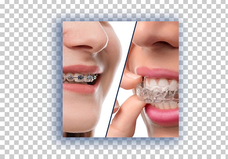 Clear Aligners Orthodontics Dental Braces Dentistry PNG, Clipart, Cheek, Chin, Clear Aligners, Closeup, Cosmetic Dentistry Free PNG Download
