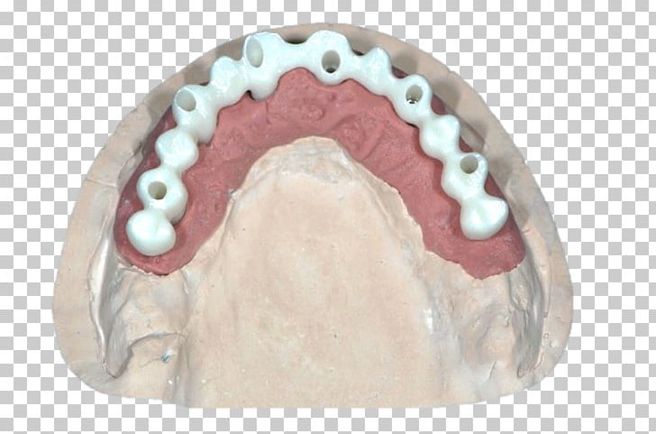 Bridge Jaw Dental Implant Diagnostic Wax-up Zirconium Dioxide PNG, Clipart, Bridge, Dental Implant, Dentition, Diagnostic Waxup, Image Scanner Free PNG Download