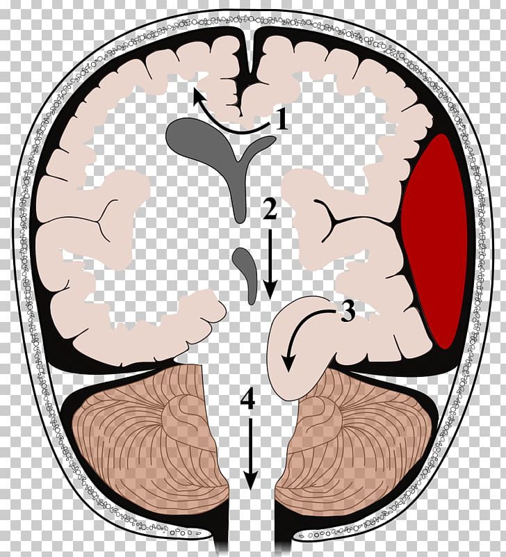 Brain Herniation Intracranial Pressure Traumatic Brain Injury Kernohan's Notch PNG, Clipart,  Free PNG Download