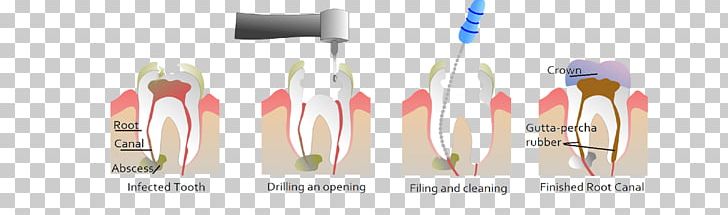 Endodontic Therapy Root Canal Dentistry PNG, Clipart, Brush, Cutlery, Dental Extraction, Dental Implant, Dental Surgery Free PNG Download