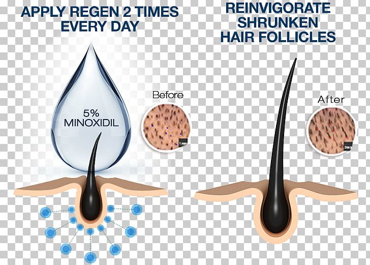 Minoxidil Management Of Hair Loss Hair Follicle Human Hair Growth PNG,  Clipart, Afrotextured Hair, Hair, Hair