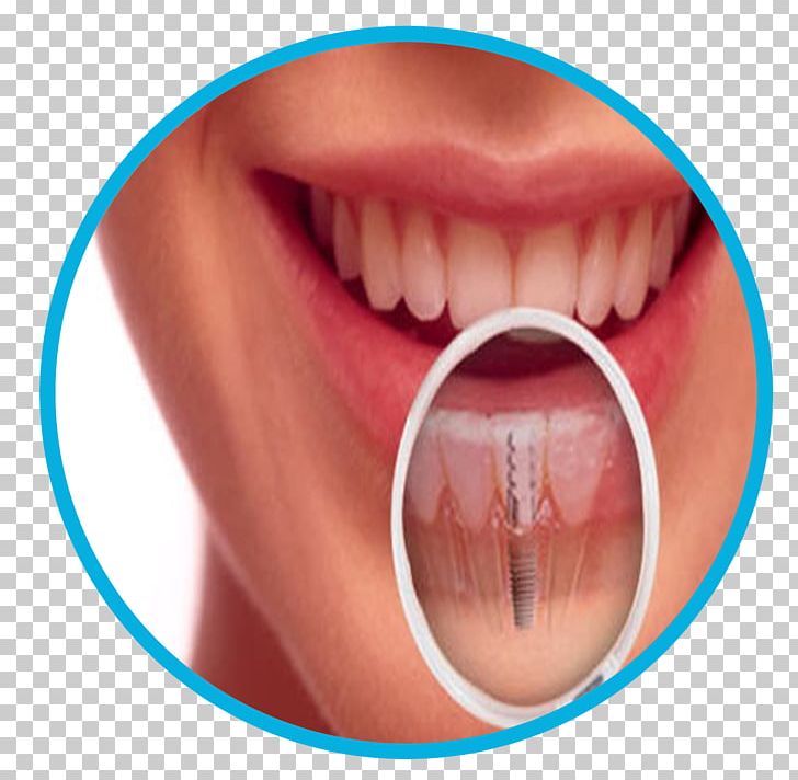 Dentistry Dental Implant Tooth PNG, Clipart, Cheek, Chin, Closeup, Cosmetic Dentistry, Dental Free PNG Download