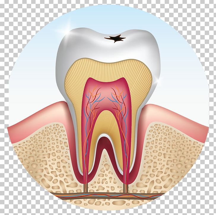 Human Tooth Wisdom Tooth Premolar Tooth Decay PNG, Clipart, Canine Tooth, Cause, Cavity, Decay, Dental Calculus Free PNG Download