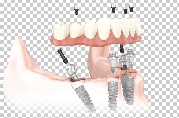 Dental Implant All-on-4 Dentistry Dentures PNG, Clipart, All On 4, Allon4, Bridge, Cosmetic Dentistry, Dental Free PNG Download