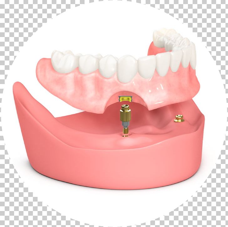 Tooth Dental Implant Dentistry Dentures Prosthesis PNG, Clipart, Cosmetic Dentistry, Dental Implant, Dentist, Dentistry, Dent Smile Free PNG Download
