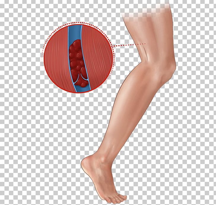 Deep Vein Thrombosis Human Leg Thigh Thrombus PNG, Clipart, Abdomen, Active Undergarment, Ankle, Arm, Blood Vessel Free PNG Download