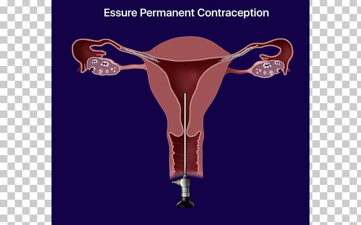 Essure Birth Control Sterilization Intrauterine Device Copper IUDs PNG, Clipart, Birth Control, Birth Control Implant, Copper Iuds, Essure, Family Planning Free PNG Download