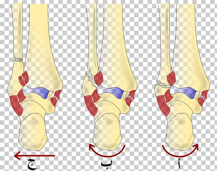 Danis–Weber Classification Ankle Fracture Lauge-Hansen Classification Bone Fracture Malleolus PNG, Clipart,  Free PNG Download