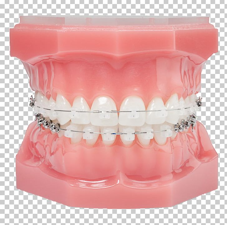 Damon System Orthodontics Dental Braces Clear Aligners Self-ligating Bracket PNG, Clipart, Clear Aligners, Crossbite, Damon, Damon System, Dental Braces Free PNG Download