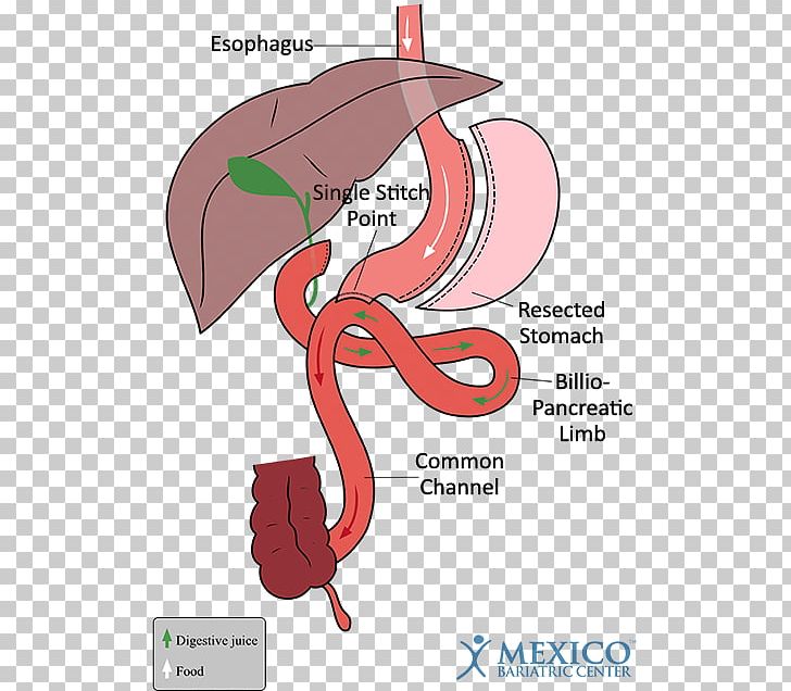 Duodenal Switch Gastric Bypass Surgery Sleeve Gastrectomy Bariatric Surgery PNG, Clipart, Art, Bariatric Surgery, Bypass, Bypass Surgery, Cartoon Free PNG Download