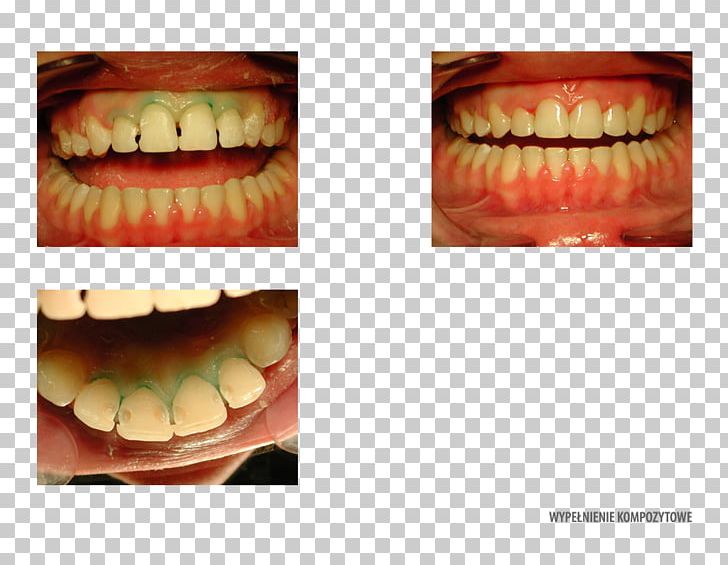 Tooth Decay Dentistry Orthodontics Orange PNG, Clipart, Clinic, Closeup, Composite Material, Cosmetic Dentistry, Dentistry Free PNG Download