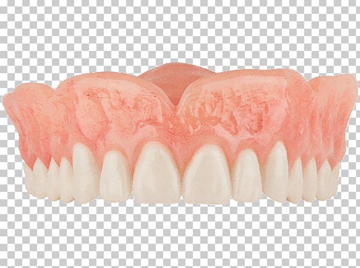 Tooth Dentures Dentistry Removable Partial Denture PNG, Clipart, Aspen Dental, Dental Implant, Dentist, Dentistry, Dentures Free PNG Download