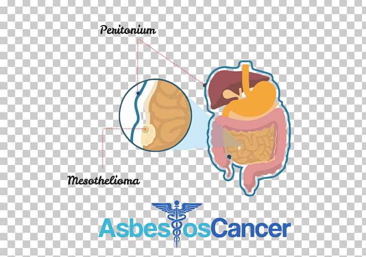 Peritoneal Mesothelioma Cancer Peritoneum Mesothelium PNG, Clipart, Abdomen, Asbestos, Cancer, Diagram, Disease Free PNG Download