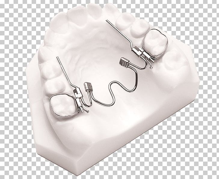 Nickel Titanium Palatal Expansion ResearchGate Material Quad Helix PNG, Clipart, 9mm, Dentistry, Expander Graph, Material, Medical Equipment Free PNG Download