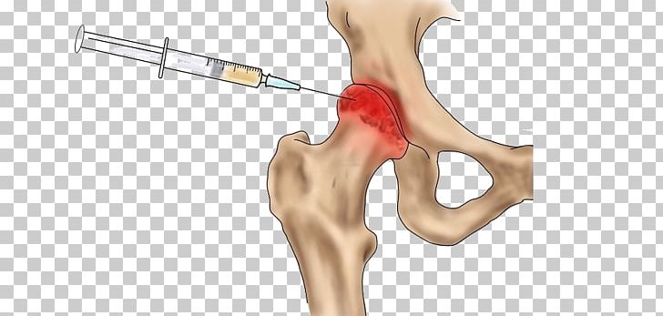 Bone Hip Thumb Osteoarthritis Femur PNG, Clipart, Arm, Arthritis, Ball And Socket Joint, Breakthrough, Ear Free PNG Download