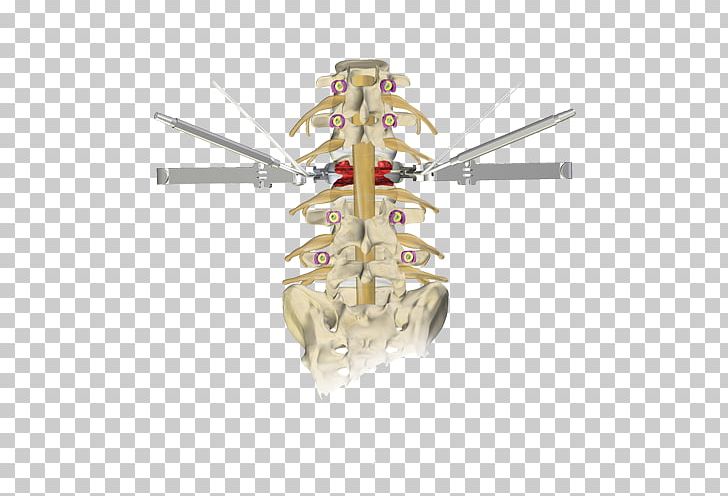 Osteotomy Vertebral Column Surgery Kyphosis Lumbar Vertebrae PNG, Clipart, Bone, Cervical Vertebrae, Hospital, Kyphosis, Lumbar Free PNG Download