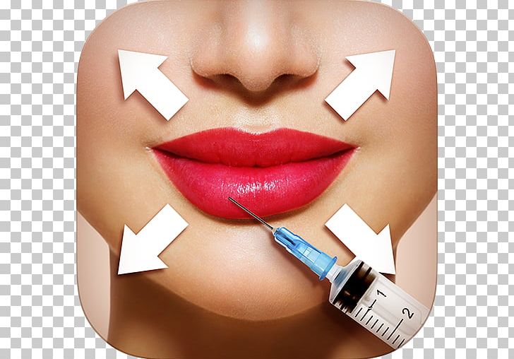 Lip Augmentation Injectable Filler Juvéderm Lip Balm PNG, Clipart, Botox, Camera, Cheek, Chin, Cosmetics Free PNG Download
