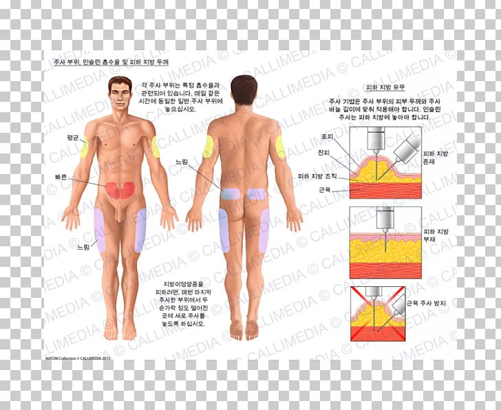 Insulin Subcutaneous Injection Dermatology Skin PNG, Clipart, Abdomen, Absorption, Active Undergarment, Apparatus, Arm Free PNG Download