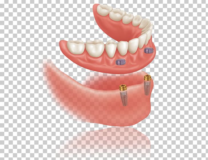 Dental Implant Dentures Dentistry PNG, Clipart, Allon4, Bridge, Cosmetic Dentistry, Dental Implant, Dentist Free PNG Download