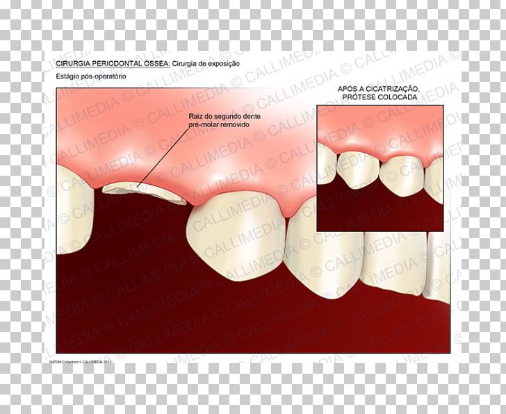 Tooth Crown Lengthening Dentistry Surgery PNG, Clipart, Bone, Crown, Crown Lengthening, Dentin, Dentistry Free PNG Download