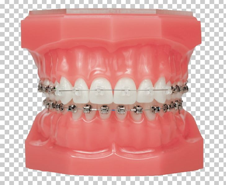Damon System Dental Braces Clear Aligners Orthodontics Self-ligating Bracket PNG, Clipart, Clear Aligners, Clinic, Cosmetic Dentistry, Damon System, Dental Braces Free PNG Download