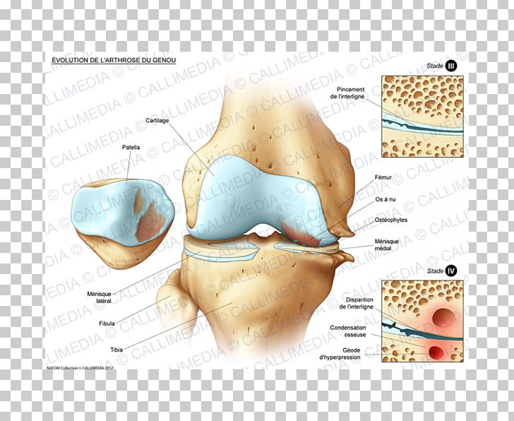 Bone Fracture Knee Disease Joint Tibia PNG, Clipart, Bone, Bone Fracture, Carpal Bones, Disease, Ear Free PNG Download
