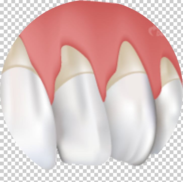 Gums Gingival Recession Gingivitis Periodontal Disease Cure PNG, Clipart, Ano, Bleeding On Probing, Cure, Dentistry, Gingival Graft Free PNG Download