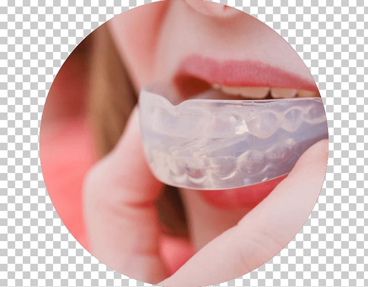 Mouthguard Bruxism Dentistry PNG, Clipart, Cheek, Chin, Closeup, Dental Public Health, Dentist Free PNG Download