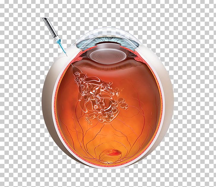 Intravitreal Administration Macular Degeneration Injection Bevacizumab Anti–vascular Endothelial Growth Factor Therapy PNG, Clipart, Agerelated Eye Disease Study, Bevacizumab, Diabetic Retinopathy, Eye, Glass Free PNG Download