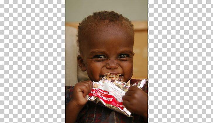 Infant Malnutrition Child Health Mortality Rate PNG, Clipart,  Free PNG Download