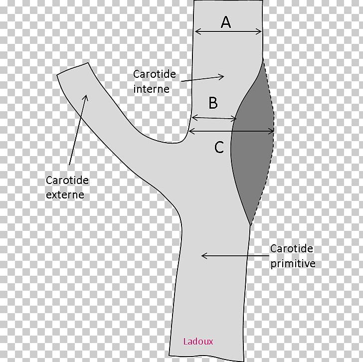 Carotid Artery Stenosis Common Carotid Artery Internal Carotid Artery Doppler Ultrasonography PNG, Clipart, Abdomen, Angle, Area, Arm, Carotid Artery Stenosis Free PNG Download