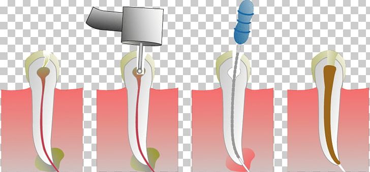 Endodontic Therapy Root Canal Dentist Endodontics Pulp PNG, Clipart, Brush, Canal, Cosmetic Dentistry, Dental, Dental Extraction Free PNG Download
