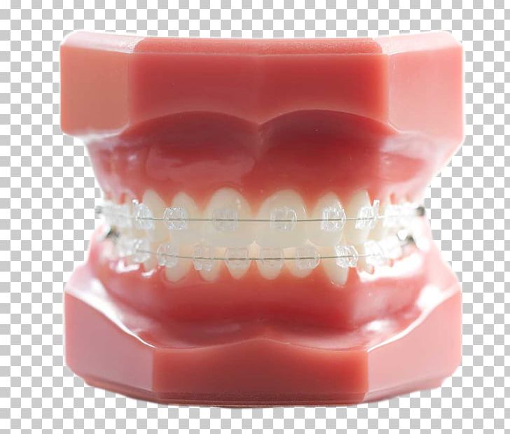 Tooth Orthodontics Dentistry Dental Braces PNG, Clipart, Anatomy, Dental Braces, Dental Laboratory, Dental Model, Dentist Free PNG Download