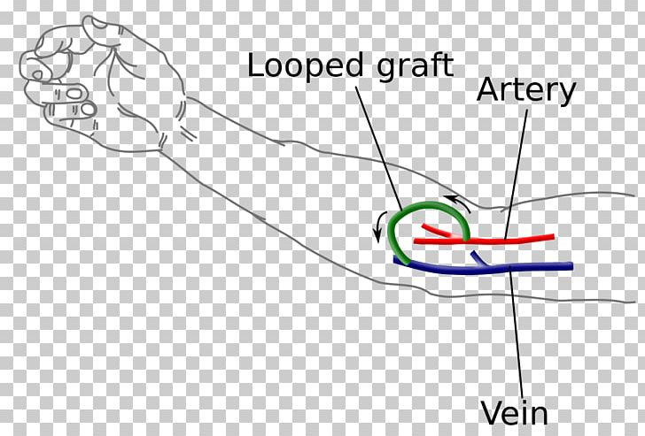 Arteriovenous Fistula Hemodialysis Vascular Access Vascular Surgery PNG, Clipart, Acute Kidney Failure, Anastomosis, Angle, Area, Arm Free PNG Download