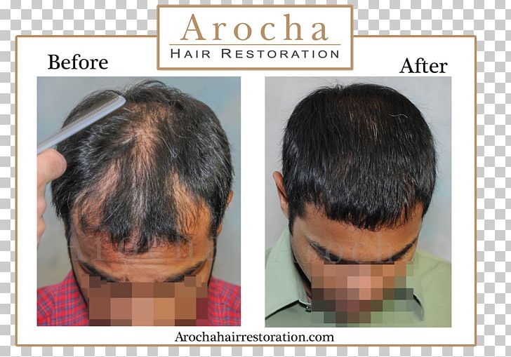 Forehead Hair Transplantation Graft Hair Loss Follicular Unit Extraction PNG, Clipart, Cheek, Chin, Ear, Eyebrow, Face Free PNG Download
