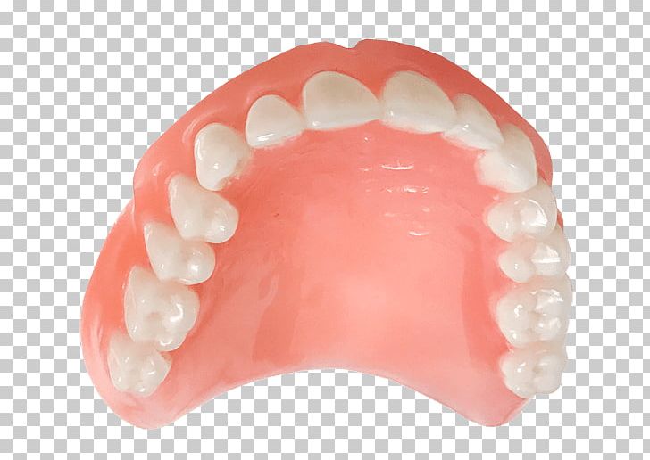 Tooth Dentures Implant Prosthesis Fixfogsor Rendelő PNG, Clipart, Body, Dentures, Food, Health, Implant Free PNG Download