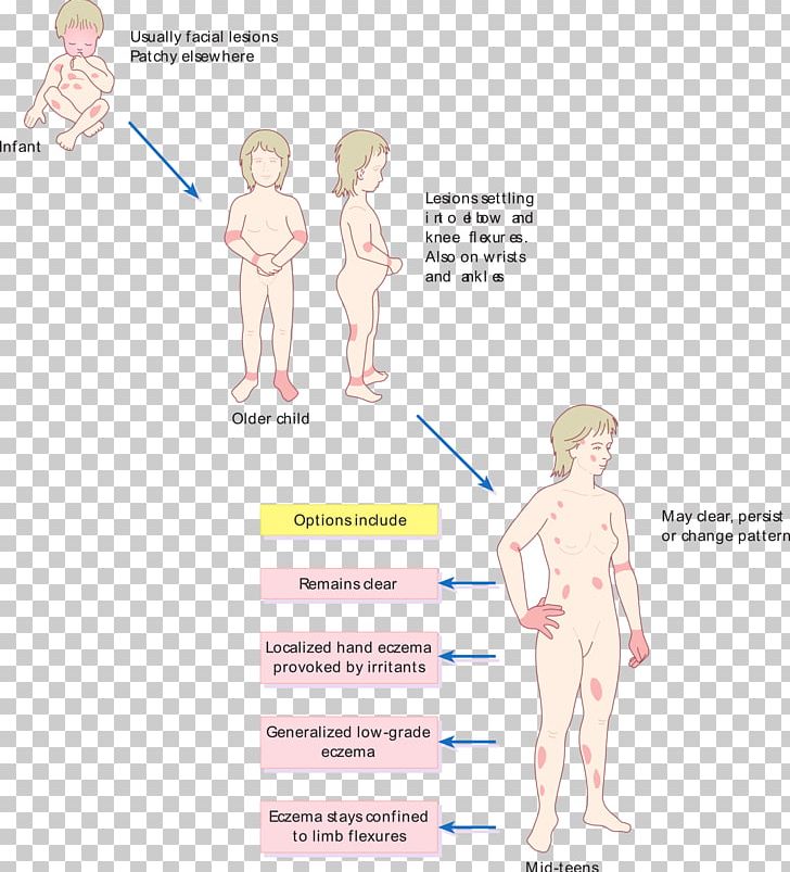 Atopic Dermatitis Atopy Disease Itch PNG, Clipart, Abdomen, Allergy, Arm, Atopic Dermatitis, Atopy Free PNG Download