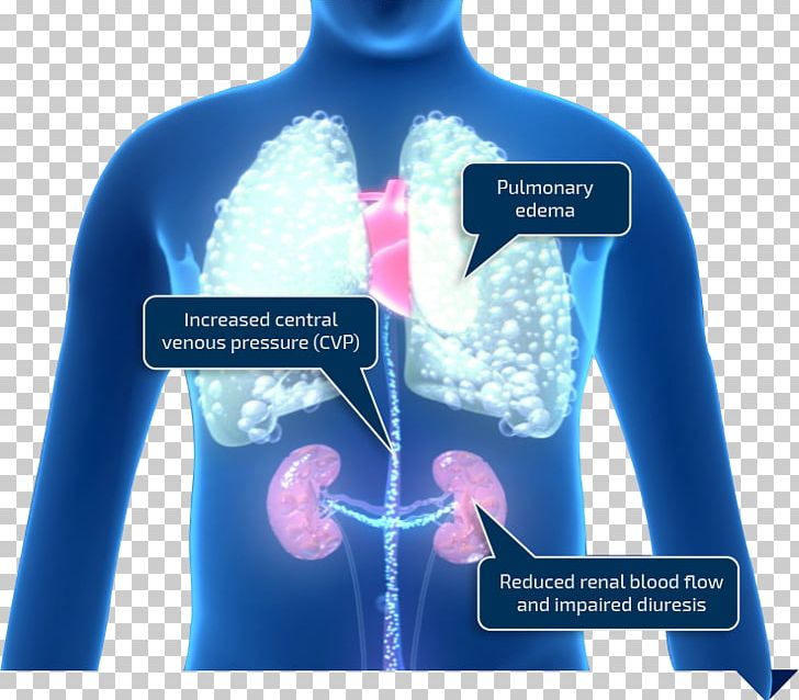 Vein Heart Ailment Medicine Dyspnea Pulmonary Embolism PNG, Clipart, Chronic Venous Insufficiency, Dyspnea, Electric Blue, Heart, Infarction Free PNG Download