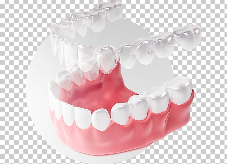 Tooth Элайнер Dental Braces Clear Aligners Zwarcie PNG, Clipart, Clear Aligners, Crowding Of Teeth, Dental Braces, Dental Implant, Dentistry Free PNG Download