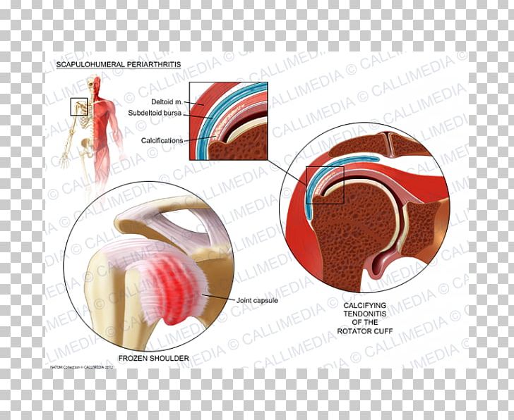 Shoulder Periarthritis Periartrite Scapolo-omerale Rheumatology PNG, Clipart, Arthritis, Calcific Tendinitis, Cyclobenzaprine, Disease, Ear Free PNG Download