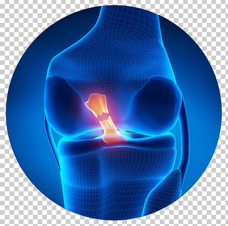 Anterior Cruciate Ligament Injury Medial Collateral Ligament Anterior Cruciate Ligament Reconstruction PNG, Clipart, Acl, Anterior Cruciate Ligament, Anterior Cruciate Ligament Injury, Cruciate Ligament, Electric Blue Free PNG Download
