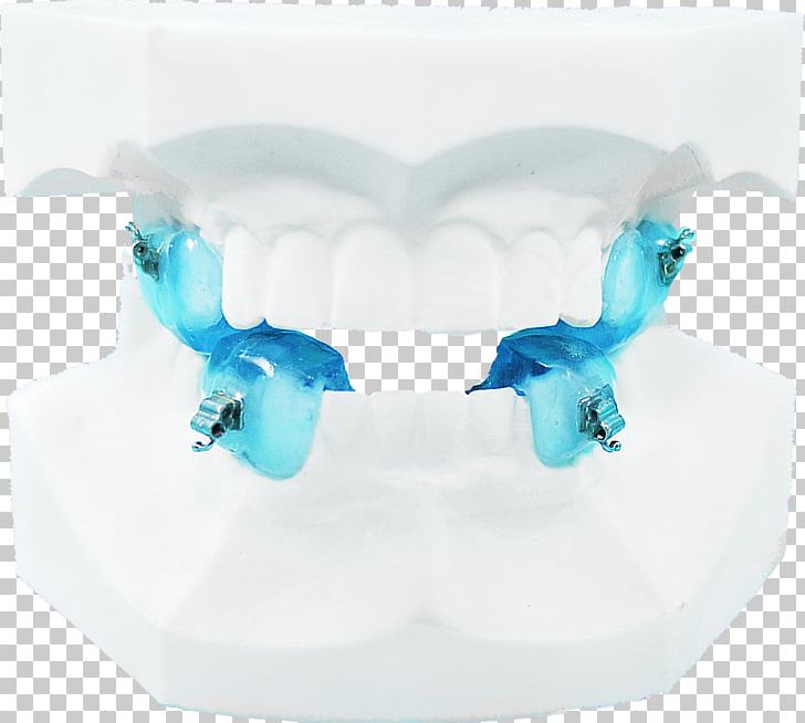 Jaw Orthodontics Dental Braces Twin Block Appliance Therapy PNG, Clipart, Aqua, Blue, Body Jewelry, Clinic, Crystal Free PNG Download