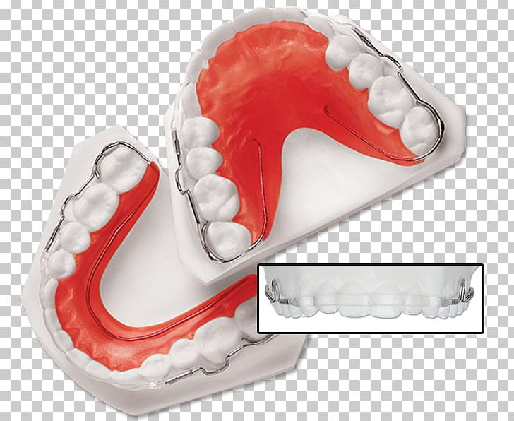 Tooth Retainer Orthodontics Dentistry Dental Braces PNG, Clipart, Dental Braces, Dentistry, Electrical Wires Cable, Finger, Jaw Free PNG Download