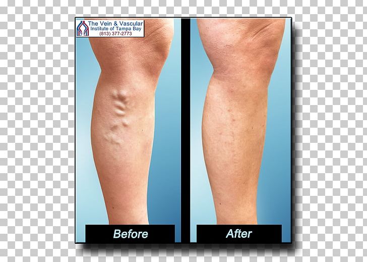 Varicose Veins Telangiectasia Surgery Endovenous Laser Treatment PNG, Clipart, Abdomen, Ankle, Arm, Calf, Chin Free PNG Download