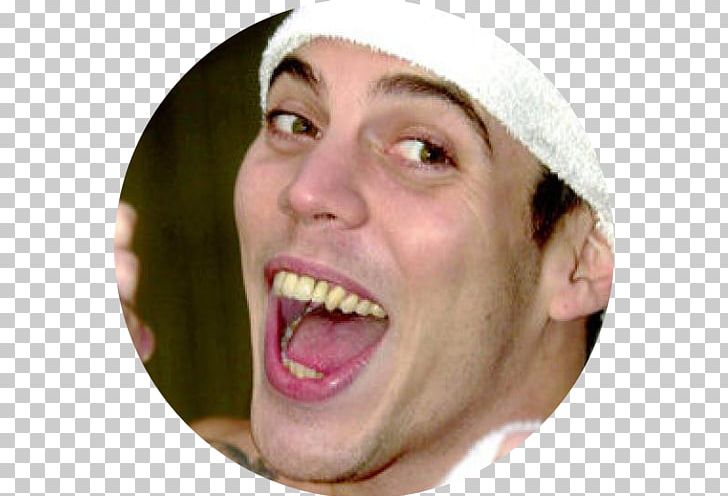 Steve-O Veneer Jackass: The Movie Celebrity Dentistry PNG, Clipart, Celebrity, Cheek, Chin, Closeup, Cosmetic Dentistry Free PNG Download