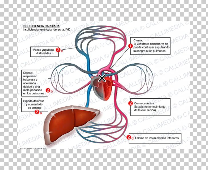 Heart Failure Systole Cardiology Symptom Ventricle PNG, Clipart, Abdominal, Aneurysm, Aortic Insufficiency, Cardiology, Diagram Free PNG Download